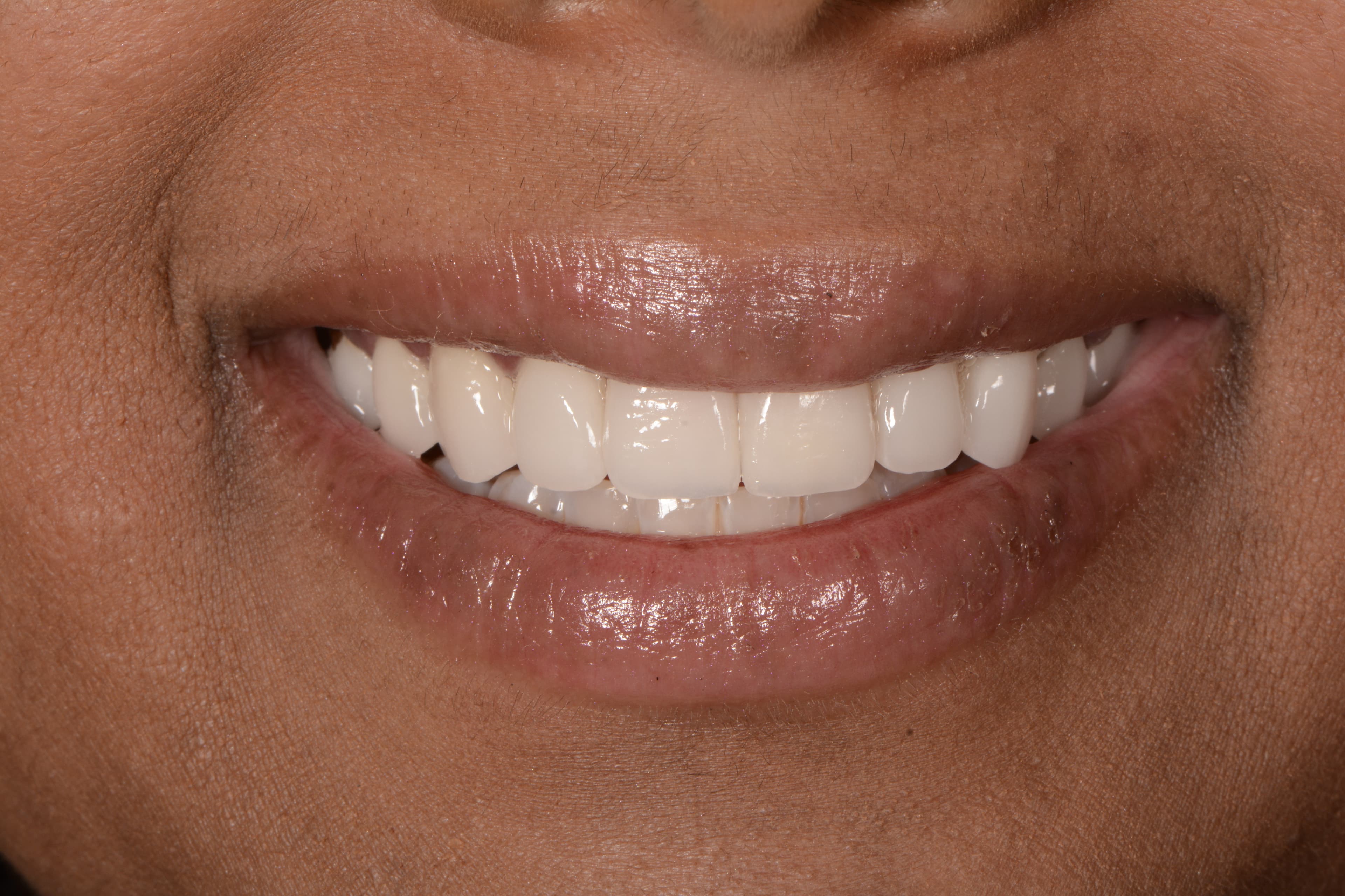 After porcelain veneers: even, bright white smile
