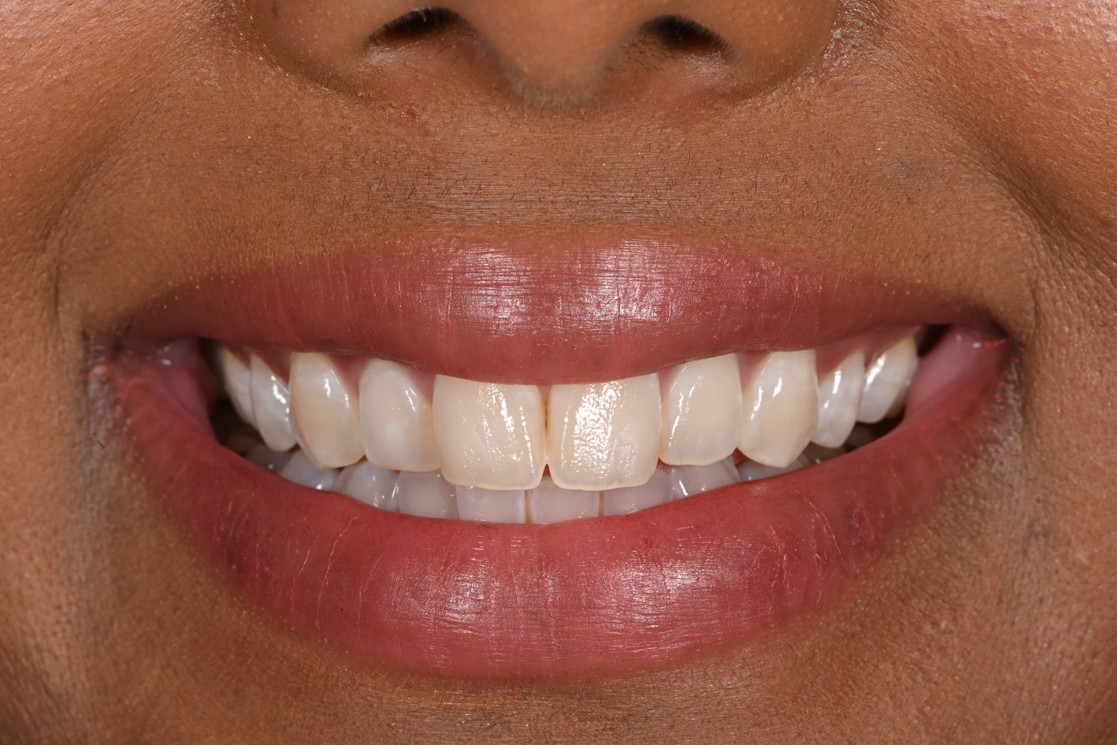 Before porcelain veneers: smile with uneven, discolored front teeth