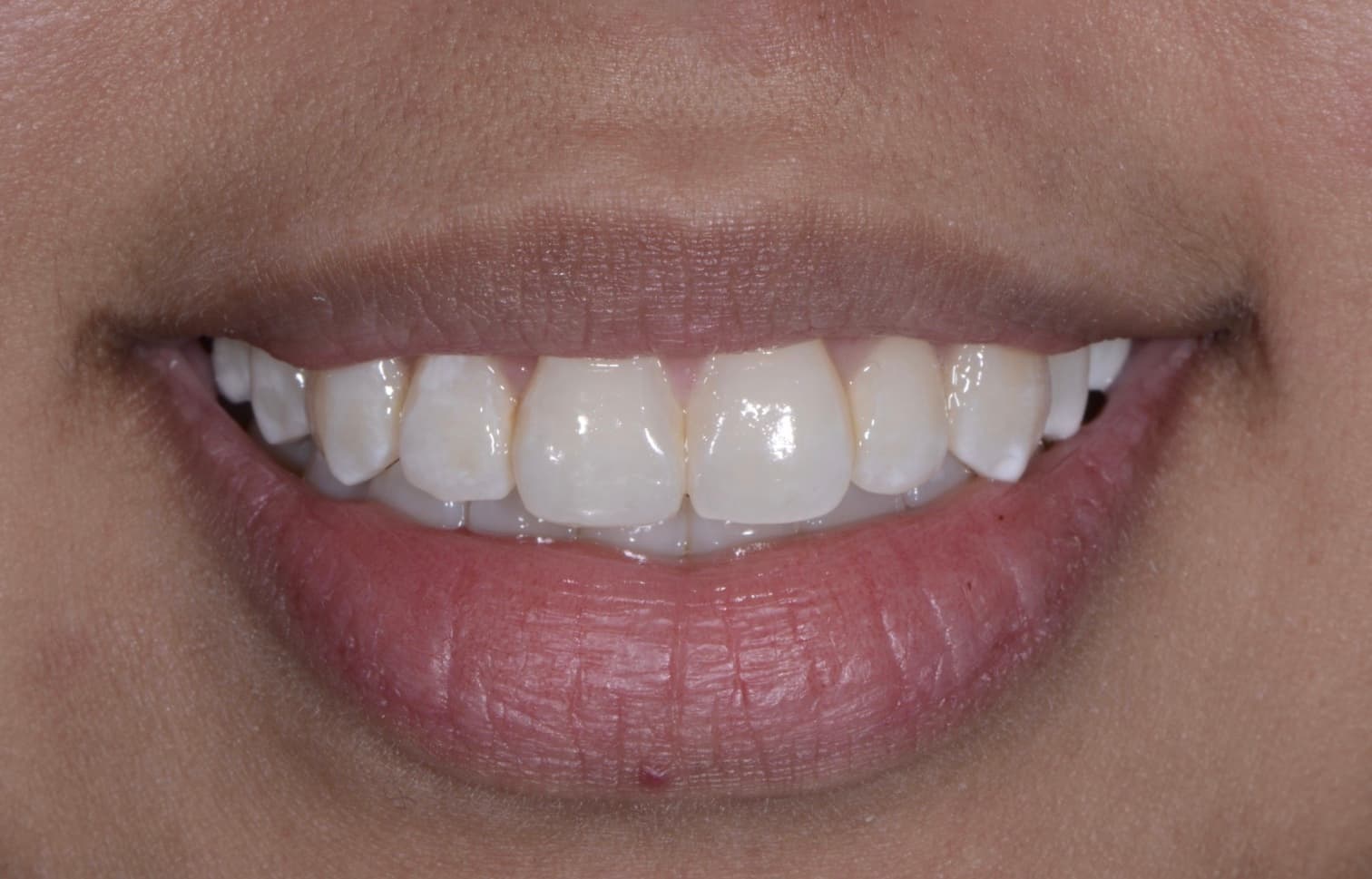 After composite bonding: chipped front tooth repaired