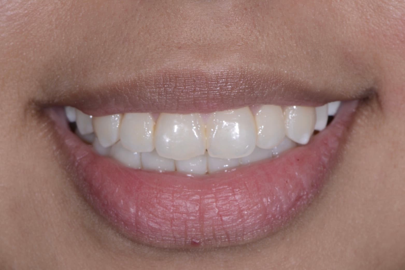 Before composite bonding: smile with a chipped front tooth